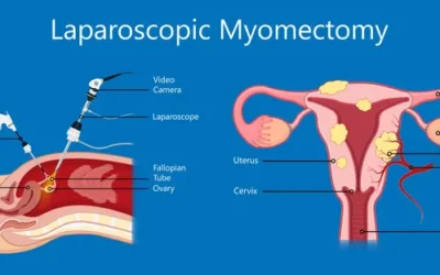 All you need to know about laparoscopic myomectomy