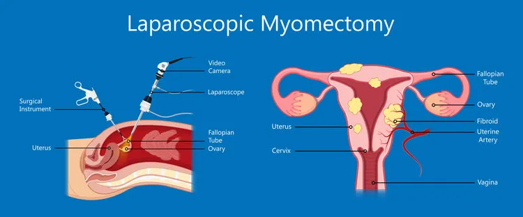 All you need to know about laparoscopic myomectomy.