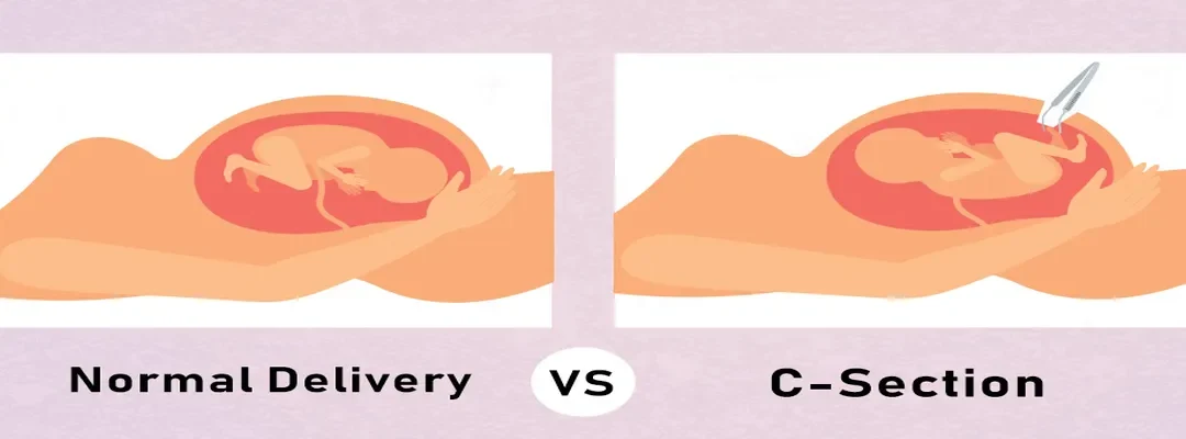 C-section versus Natural Delivery - Benefits and Risks