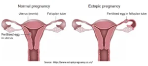 Ectopic Pregnancy in Malad