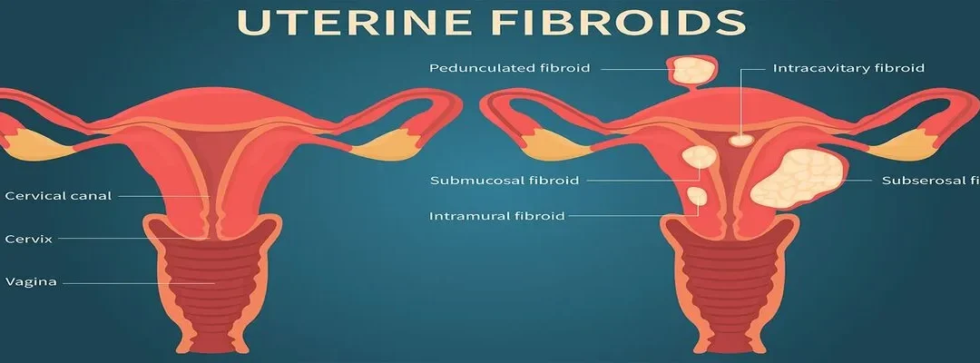 How Diet Can Help Manage Uterine Fibroids
