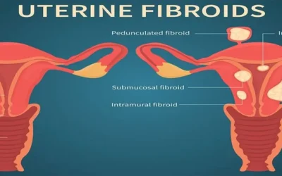 How Diet Can Help Manage Uterine Fibroids