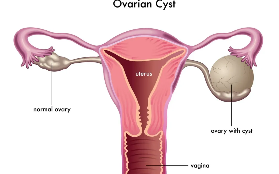 Ovarian Cysts: Symptoms and Causes