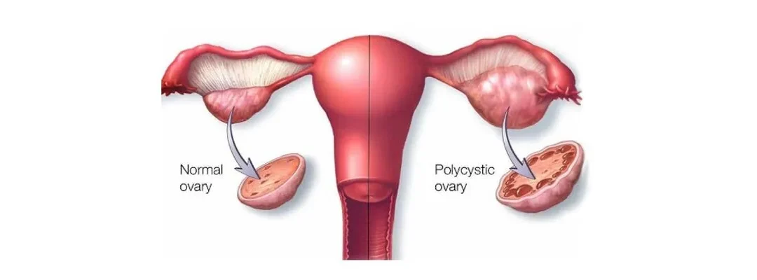 PCOS V/S PCOD – What Is The difference?