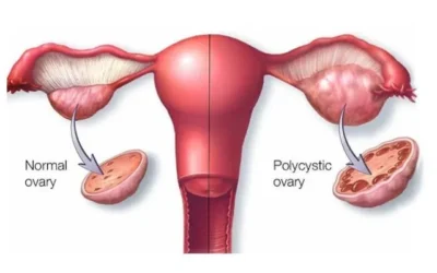 PCOS V/S PCOD – What Is The difference?