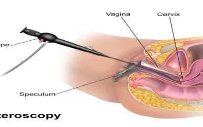 Things You Need To Know About Hysteroscopy: Uses, Procedure, Benefits & Risks