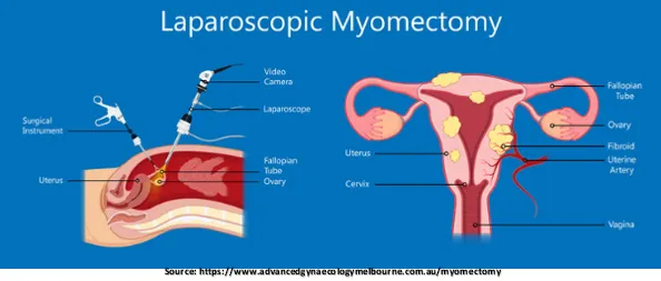 What is Laparoscopic Myomectomy?